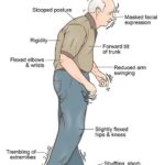 Parkinson-Disease