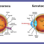 Keratoconus. Dystrophic disease of the cornea.