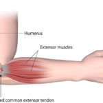 Tennis-elbow