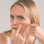 Top-10-Foods-That-Cause-Acne-1