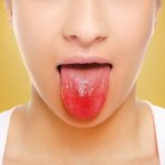 Vitamin-B12-Deficiency