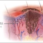 a-medical-illustration-of-melanoma-16X9