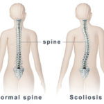 large_spine_scoliosis-e1475216613437