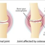 osteoarthritis_diag