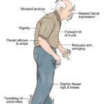 parkinson-disease (1)