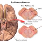 parkinsonova-bolest-1