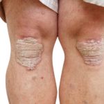 psoriasis