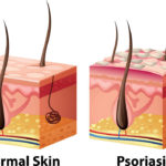 Human skin diagram with normal and psoriasis illustration