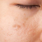 sun-damage-skin