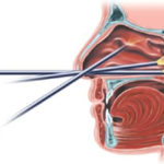 thumbnail_highlight-california-nasal-endoscopy