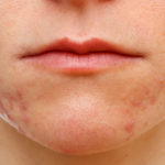 Adolescent girl suffering in acne