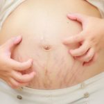 Pregnancy-and-skin-problems