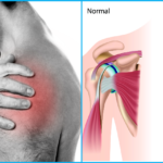 Swimming-Shoulder-Injury-SwimIndia