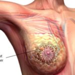 10-things-about-breast-cancer-s2-what-is-breast-cancer