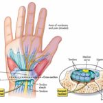 Carpal-Tunnel-Syndrome