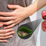 Gallstones_FB