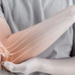 Osteoporosis-A-Useful-Guide