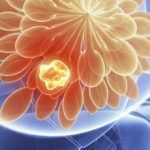 Stereotactic_Breast_Biopsy