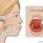 Tonsils_adenoid_MED_ILL_EN