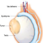 What-Men-Need-to-Know-About-Testicular-Cancer