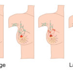 breast-cancer-screening-early-detection