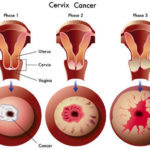 cervix-cancer-medifee