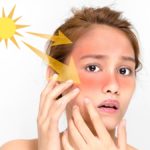 home-remedies-for-sunburn