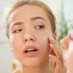 Young beautiful woman with dry irritated skin.
