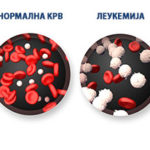 prepoznajte-gi-znacite-na-leukemija