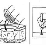 skin-biopsy