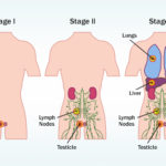 stadiji-raka-testisa-webmd