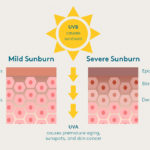 uvb-causes-sunburn