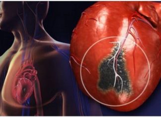 Нова комбинација на матични клетки може да помогне во опоравување на срцето по инфаркт