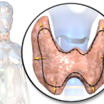 Blausen_0534_Goiter