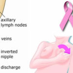 Breast-Cancer
