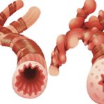 Bronchial_asthma