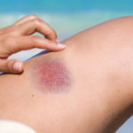 bruise-e1536147446436