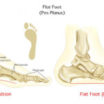flat_foot