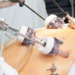 hysterectomy