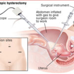 hysterectomy_1