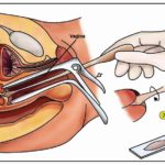 pap smear_0