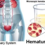 Blood-in-Urine-Hematuria-Causes-Symptoms-Diagnosis-Complications-Treatment-in-India