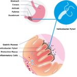 Helicobacter_Pylori_1