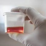 Why-is-there-blood-in-my-urine-722×406