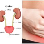 bladder-infection