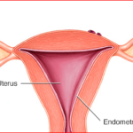 endometrioza