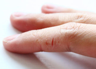 Зошто доаѓа до пукање на кожата на прстите на рацете?