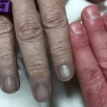 methemoglobinemia-what-it-is-causes_3