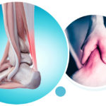nsfa-conditions-01-achilles-tendonitis-featured-01a-v2