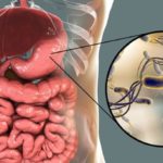 util-e-interesante-sintomas-bacteria-helicobacter-pylori-como-se-contagia-n378011-610×343-592657